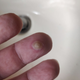 Common appearance of an Orf lesion on human skin. My skin :|